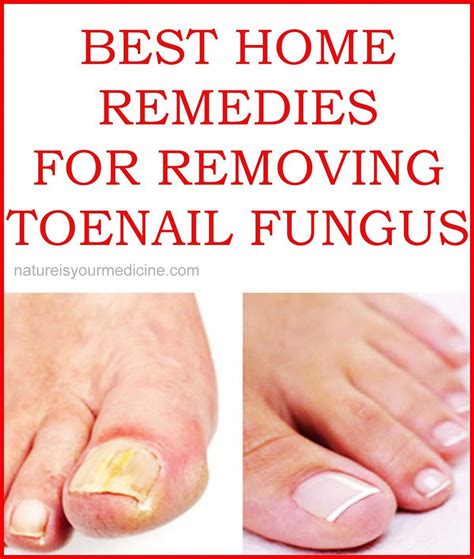 Best Home Remedies For Removing Toenail Fungus Removeeczema Toenail