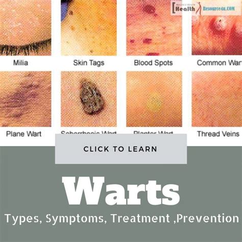 Warts Types Symptoms Treatment And Its Preventing Measures Types Of