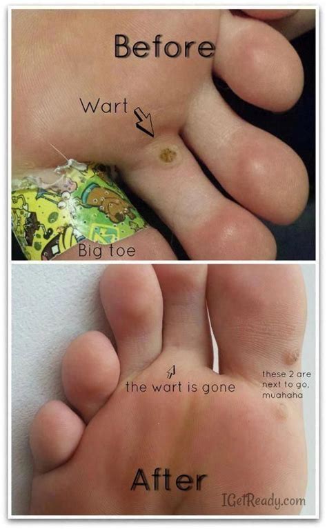 How To Remove Plantar Warts At Home Howtoremvo