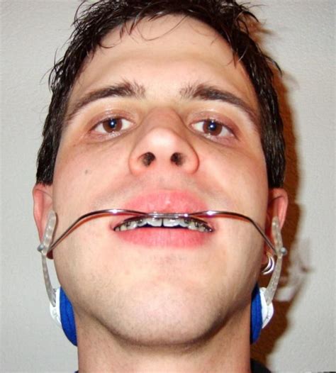 Guys With Braces Adult Braces Brace Face Metal Braces Perfect Teeth Retainers Cough