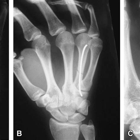 Ac A An Xray Shows A Displaced Transverse Fracture Of The Fourth