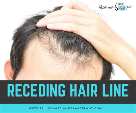 Receding Hairline How To Spot And Fix It 2022