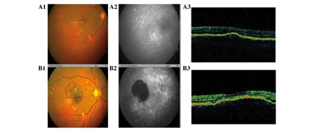 Representative Fundus Photography Ffa And Oct Images Of The Exudative