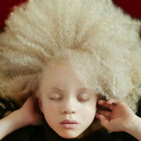 Pin By Abril On Inspiration Beauty People Albinism Albino Girl