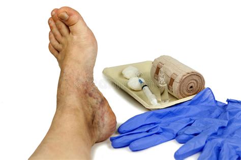 Trattamento Delle Vene Varicose Immagine Stock - Immagine di siringa