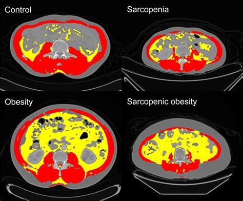 Detection Of Sarcopenic Obesity And Prediction Of Long‐term Survival In
