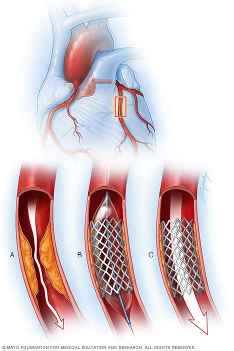 Coronary Artery Disease Diagnosis And Treatment Mayo