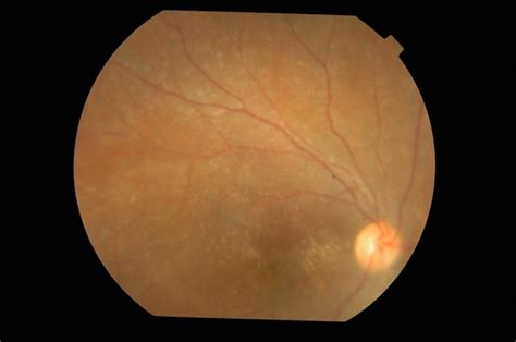 Cmv Retinitis Post Retinal Reattachment Surgery Retina Image Bank