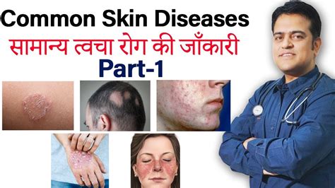 Common Skin Diseases Treatment Of Skin Problem Ringworm Psoriasis