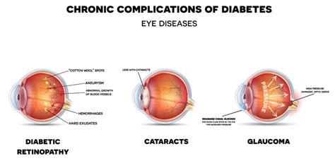 Diabetic Eye Problems Symptoms Treatment And Prevention Irisvision