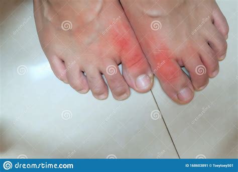 Foot Of Gout Patientclose Up Painful And Inflamed Stock Image Image