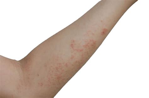 Red Rash On The Arms Kratz Allergy