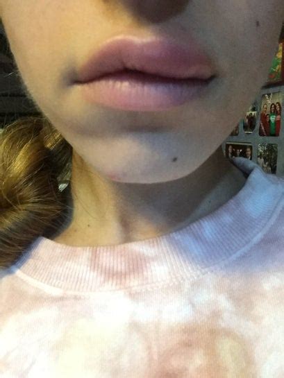 Why Do My Lips Swell So Much After Filler Sitelip Org