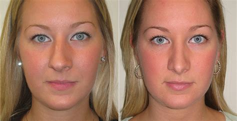 Rhinoplasty Before And After Photos The Plastic Surgery Clinic