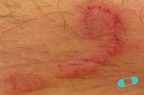 Yeast Fungal Skin Infection Skin Infection Pictures And Treatments