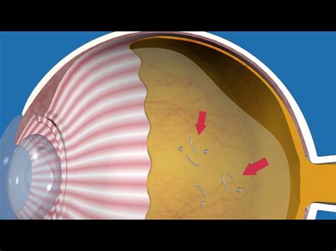 Retinal Detachment • Causes Symptoms Treatment • Murata Eyecare