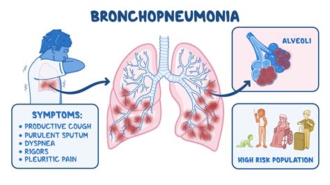 Osmosis Bronchopneumonia What Is It Contagiousness Diagnosis