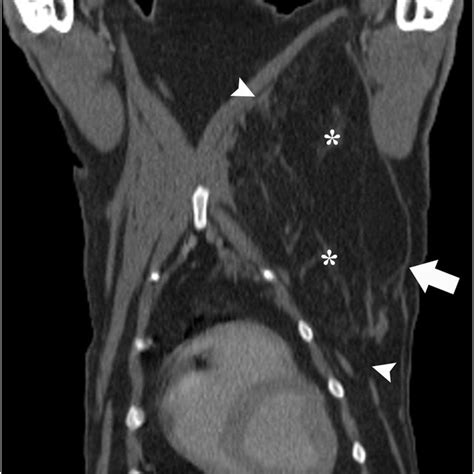 Coronal Ct Scan Of The Neck Showing A Left Supraclavicular Mass With