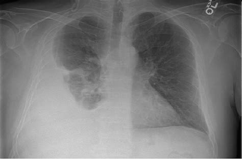 Cureus Recurrent Lymphocytic Pleural Effusion As A Complication Of My
