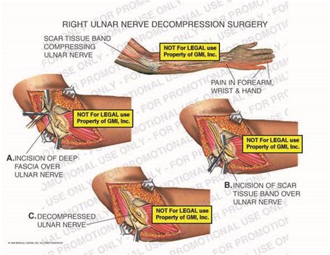 Right Ulnar Nerve Decompression Surgery 98084c31b Generic Medical