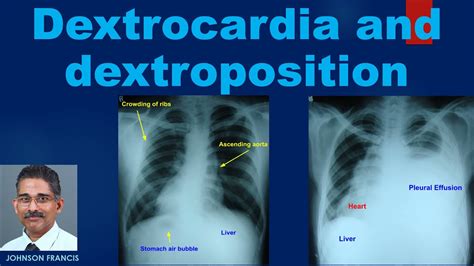 Dextrocardia And Dextroposition Youtube