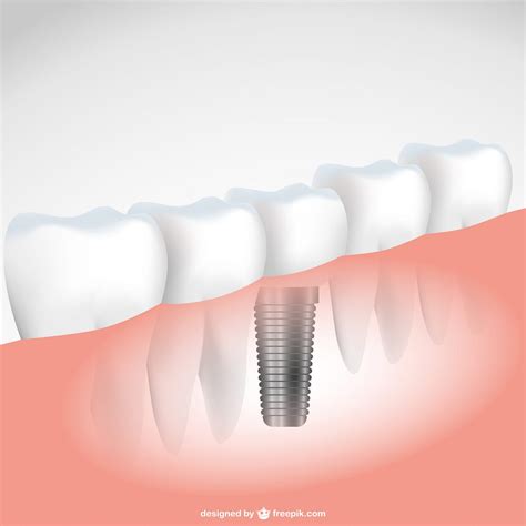 How Long Do Mini Dental Implants Last By Dr Muzzafar Zaman Dr