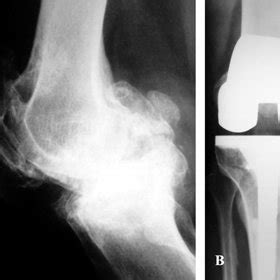 Fixed deformity fixed deformity means that the movement in the opposite direction is absent. (PDF) Total Knee Replacement in Severe Deformities