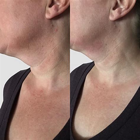 Neck Chin And Jawline Sculpting Wand Xl Spencer Barnes La