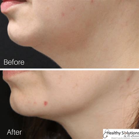 double chin reduction before and after photos healthy solutions medspa