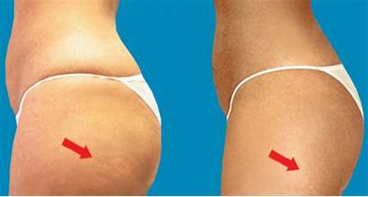 Butt Lift Implants Risks Procedure Surgery Buttock