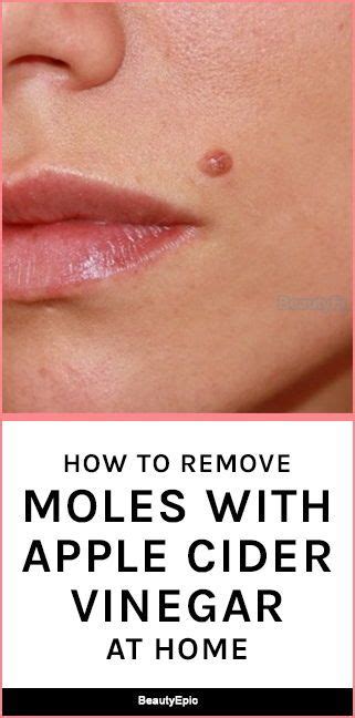 How To Remove A Mole With Apple Cider Vinegar Skin Moles Mole