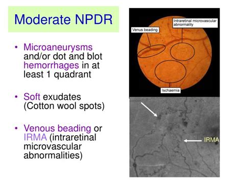 The wesdr stated that moderate npdr contains dot blot hemorrhages (dbh) or microaneurysms (ma) as numerous and severe as the standard photo 2a below in at least one quadrant, with or without cotton wool spots (cws), venous beading, or irma, but not achieving the 4:2:1 rule. PPT - DIABETIC RETINOPATHY PowerPoint Presentation - ID ...
