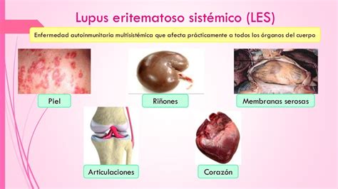 Lupus Eritematoso Sistémico