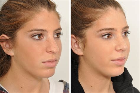 Rhinoplasty Nose Surgery Nose Job For Women In New York City David