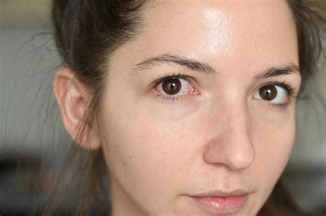 Mujer Goteando Su Ojo Con Gotas Medicinales Cerrar Ojos Marrones Inflamados Con Venas Rojas