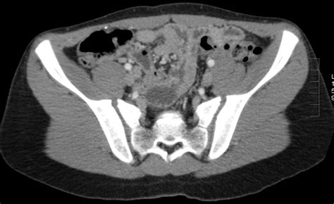 Suspected Appendicitis In Children Diagnostic Importance Of Normal