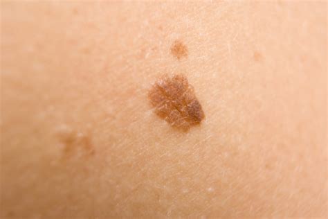 Brown Spots On Skin Prevention Treatment And Home Remedies