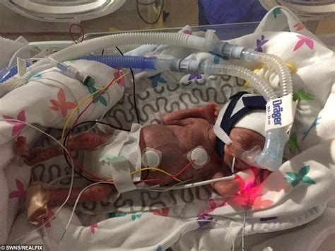 Miracle Premature Baby Who Was One Of The Smallest Ever Returns Home