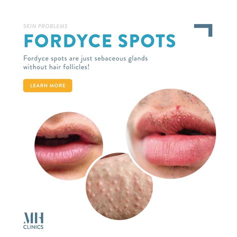 What Causes Fordyce Spots And Where Do They Develop