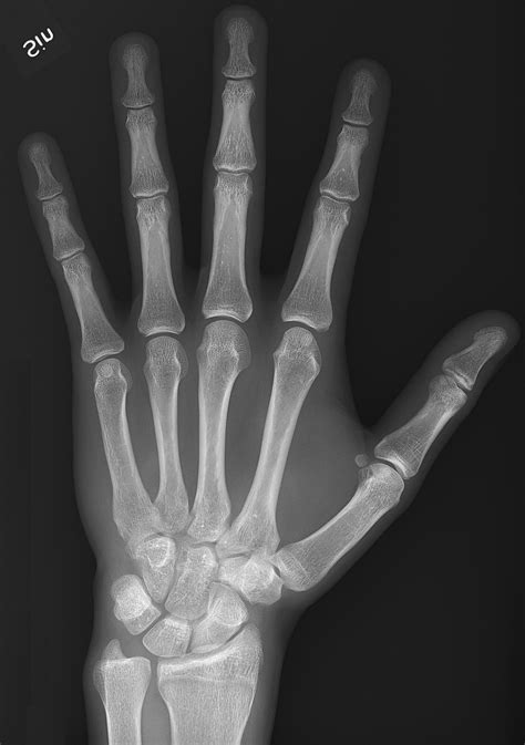 Filex Ray Of Normal Hand By Dorsoplantar Projection