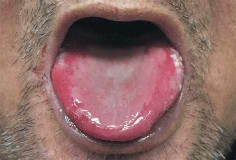 Ulcerated Lesions Of The Tongue Download Scientific Diagram
