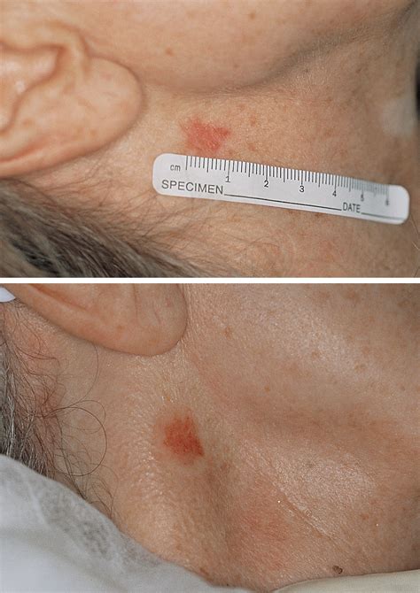 Treatment Of Superficial Basal Cell Carcinoma And Squamous Cell