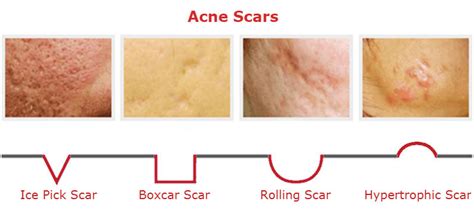 Best Acne Scar Removal Creams Clinically Tested And Proven To Work