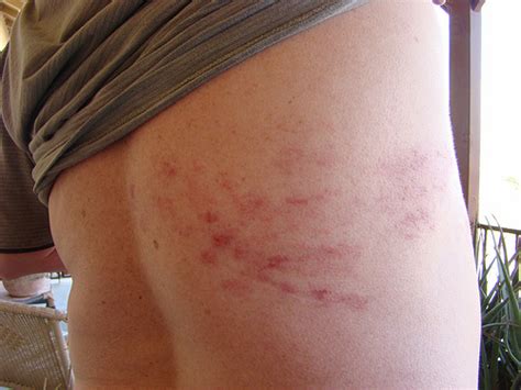 Common Facts About Chicken Pox Shingles Which One Do You Have How