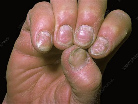 Psoriasis Of The Fingernails Stock Image C0510257 Science Photo