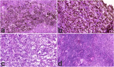 Histology Images Of Lymph Node Metastasis 2a And B The “pigmentation