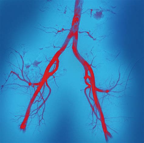 Normal Abdominal Arteries Angiogram Photograph By Miriam Maslo Fine