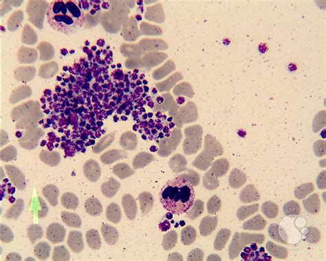 Platelet Clump In Peripheral Blood Smear