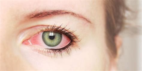 3 Common Eye Infections And How To Get Rid Of Them First Choice Eye Care Od