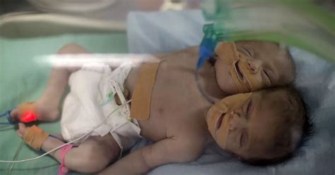 Conjoined Twins Born In Gaza With Two Heads And One Body Pictured Fighting For Life In Incubator